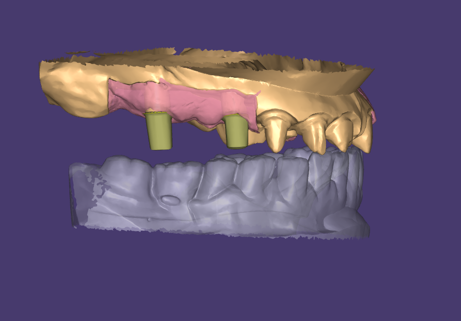 Custom Abutment Design.png
