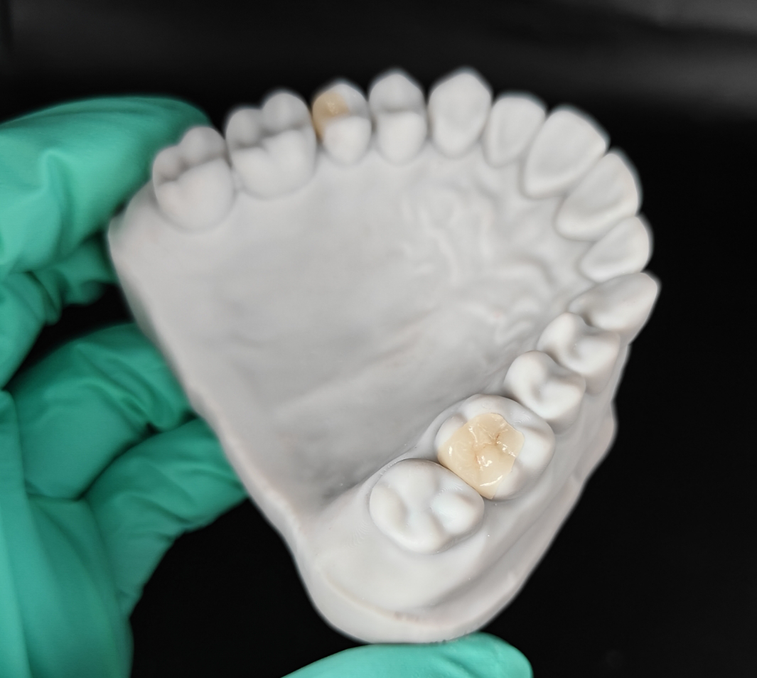 IPS e.max ceramic crown