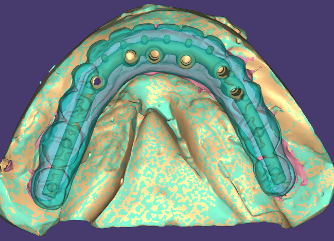 Implant Bar Design.png