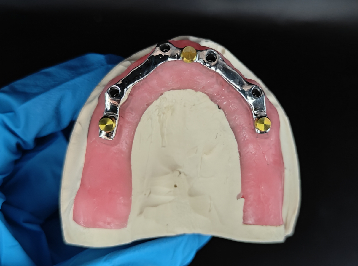 Custom implant bar