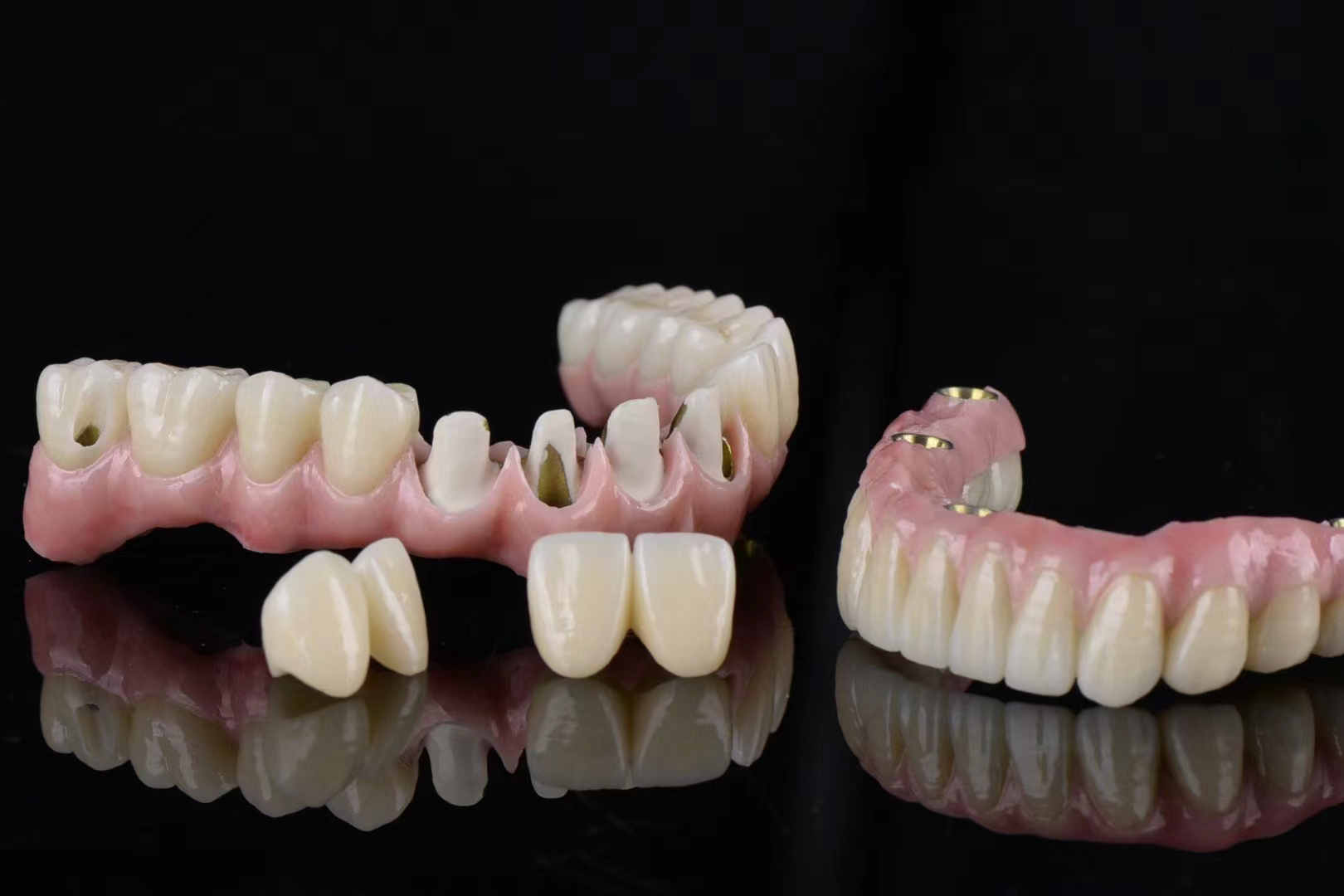 Implant crowns and bridges