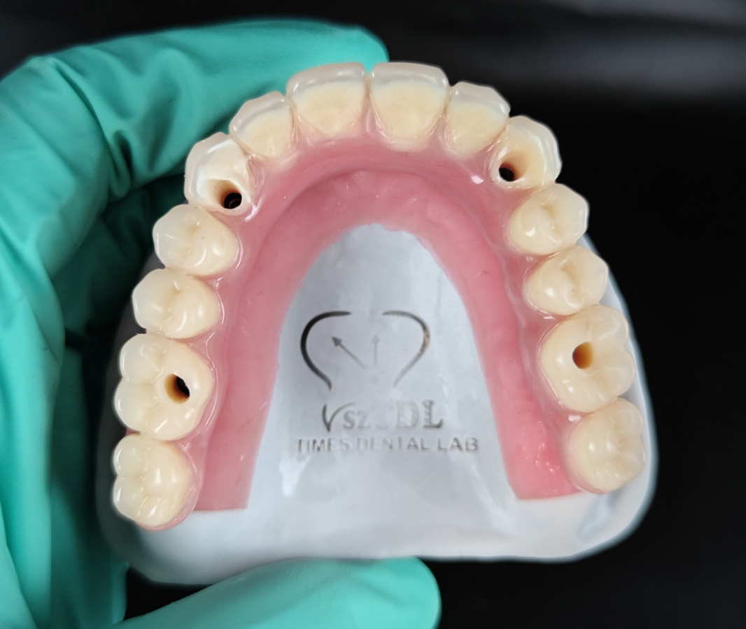 Screw-retained hybrid denture