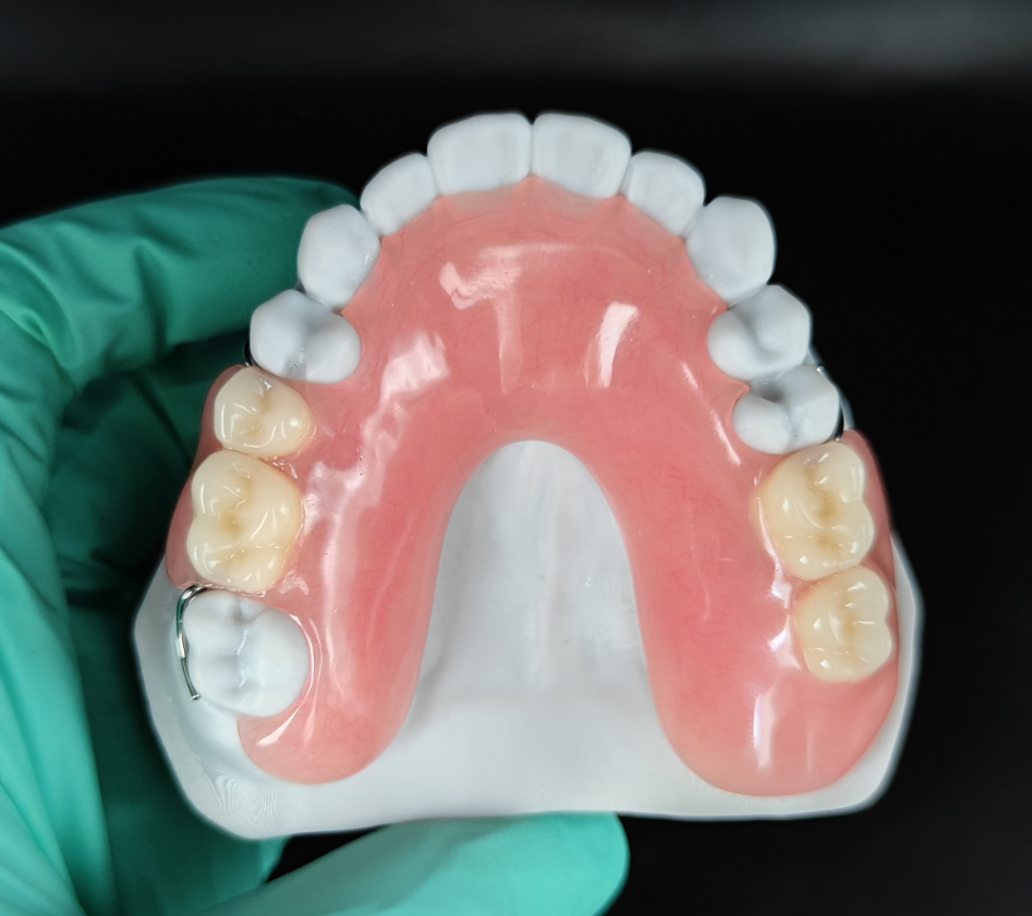 Custom acrylic denture