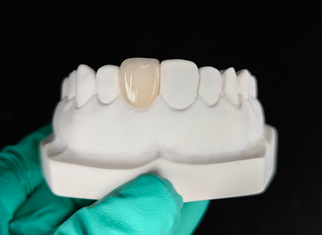 Zirconia Veneers