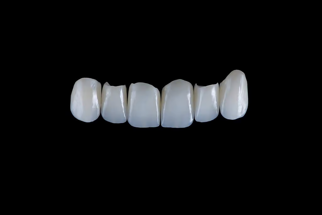 E.max ceramic veneer