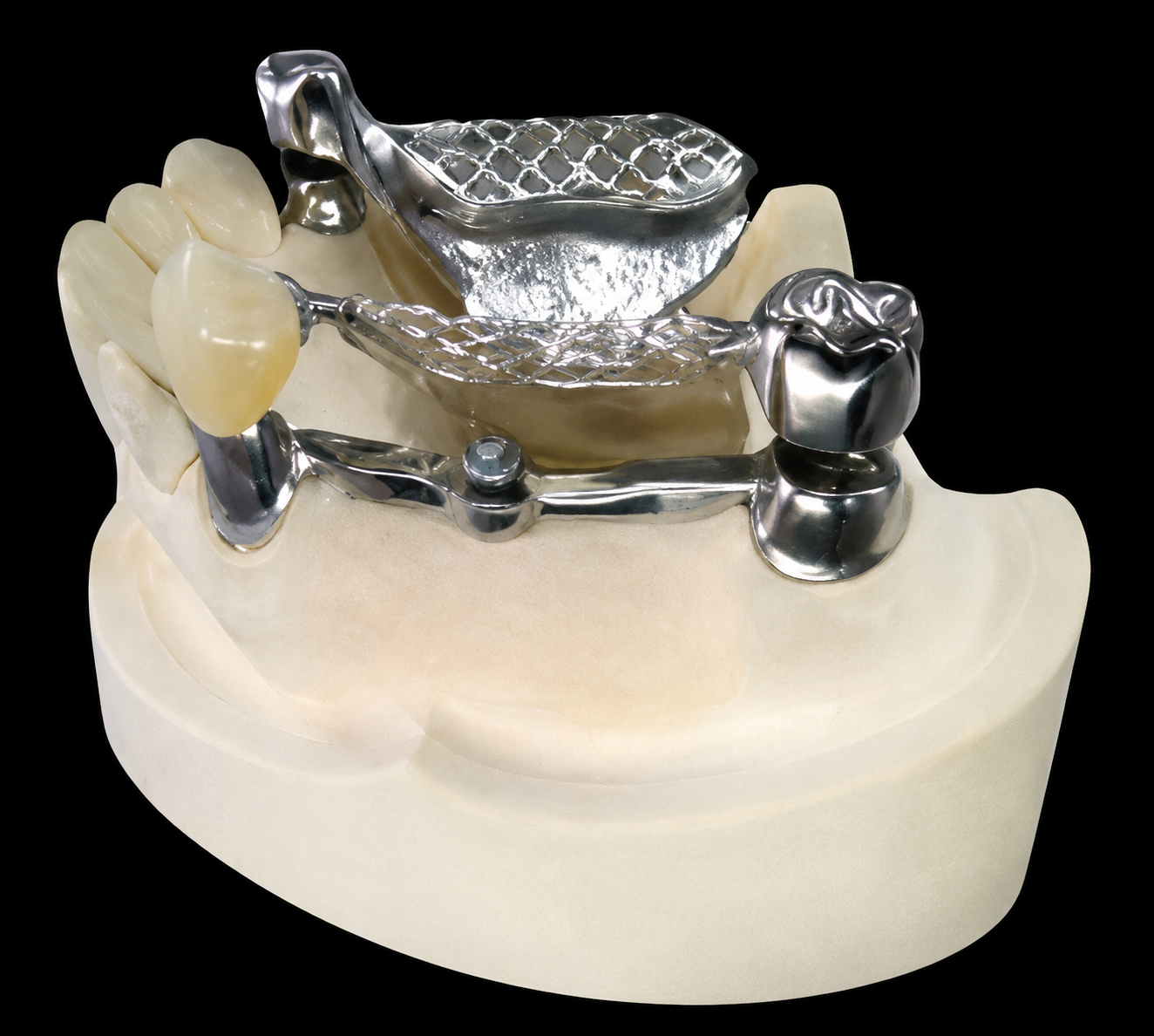 Snap attachment overdenture