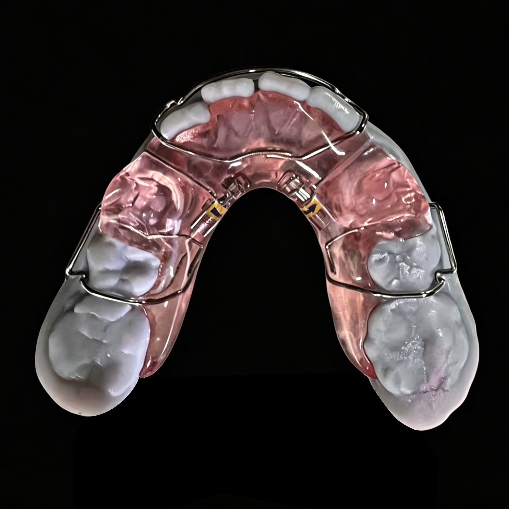 Mandibular Fixed Expander