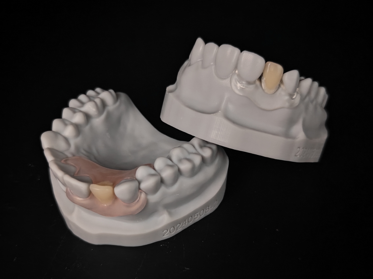 Flexible Partial Denture vs. Acrylic Partial Denture: Materials, Design and Case Selection