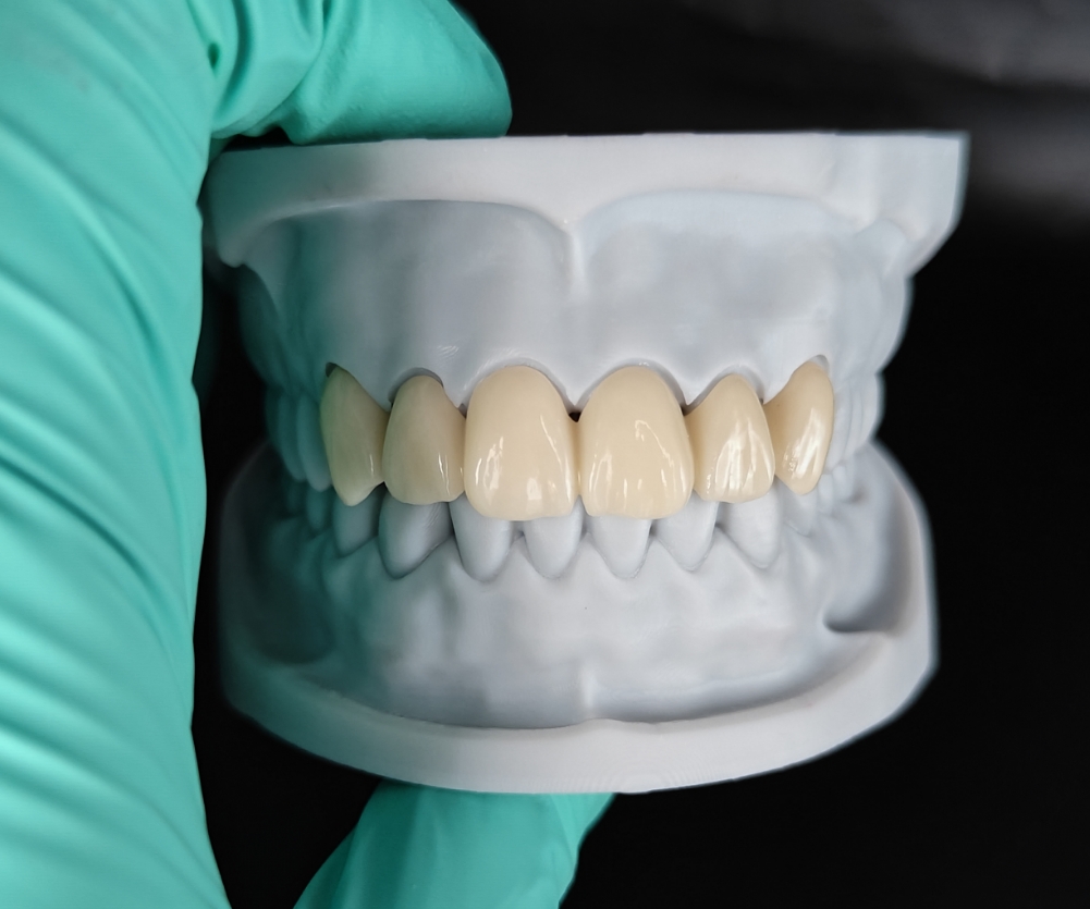 Full contour zirconia crown