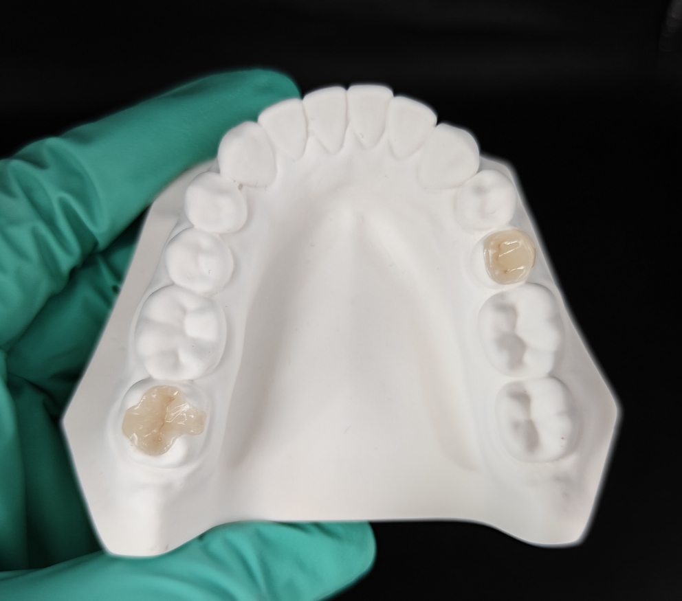 Upcera lithium disilicate crown