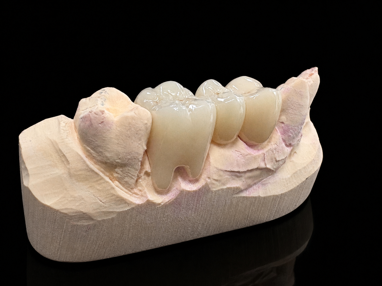 Monolithic zirconia crowns