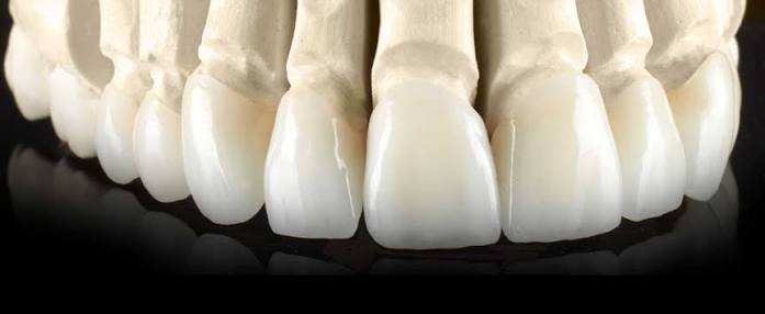 emax anterior crowns