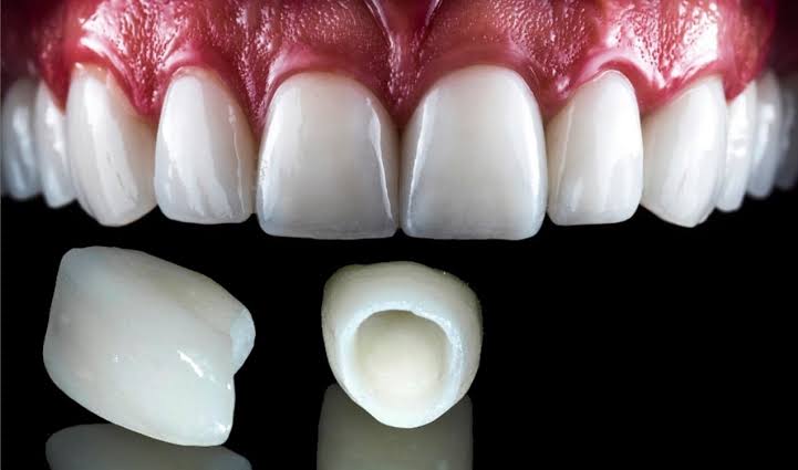 Anterior E.max restoration.jpg