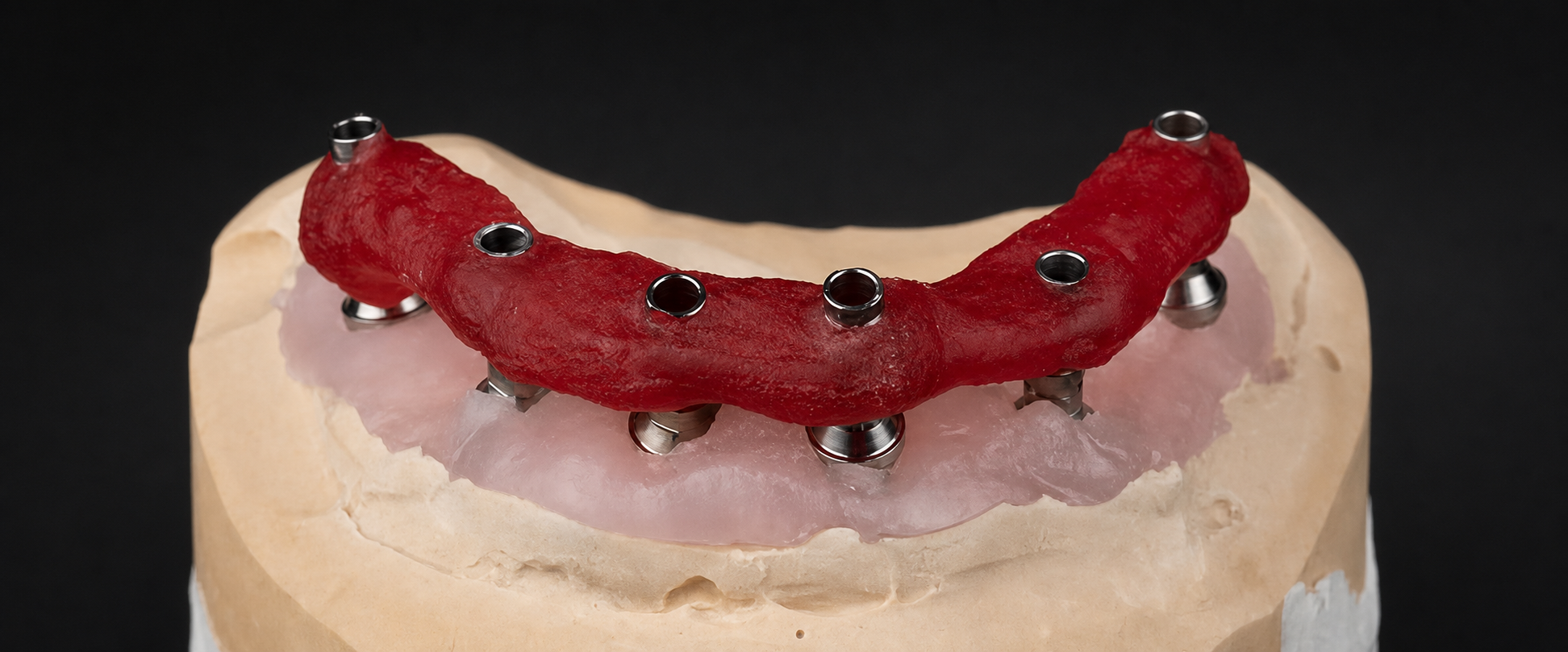 Full-Arch Implant Verification Jig: When Is It Needed and What Should the Lab Receive?