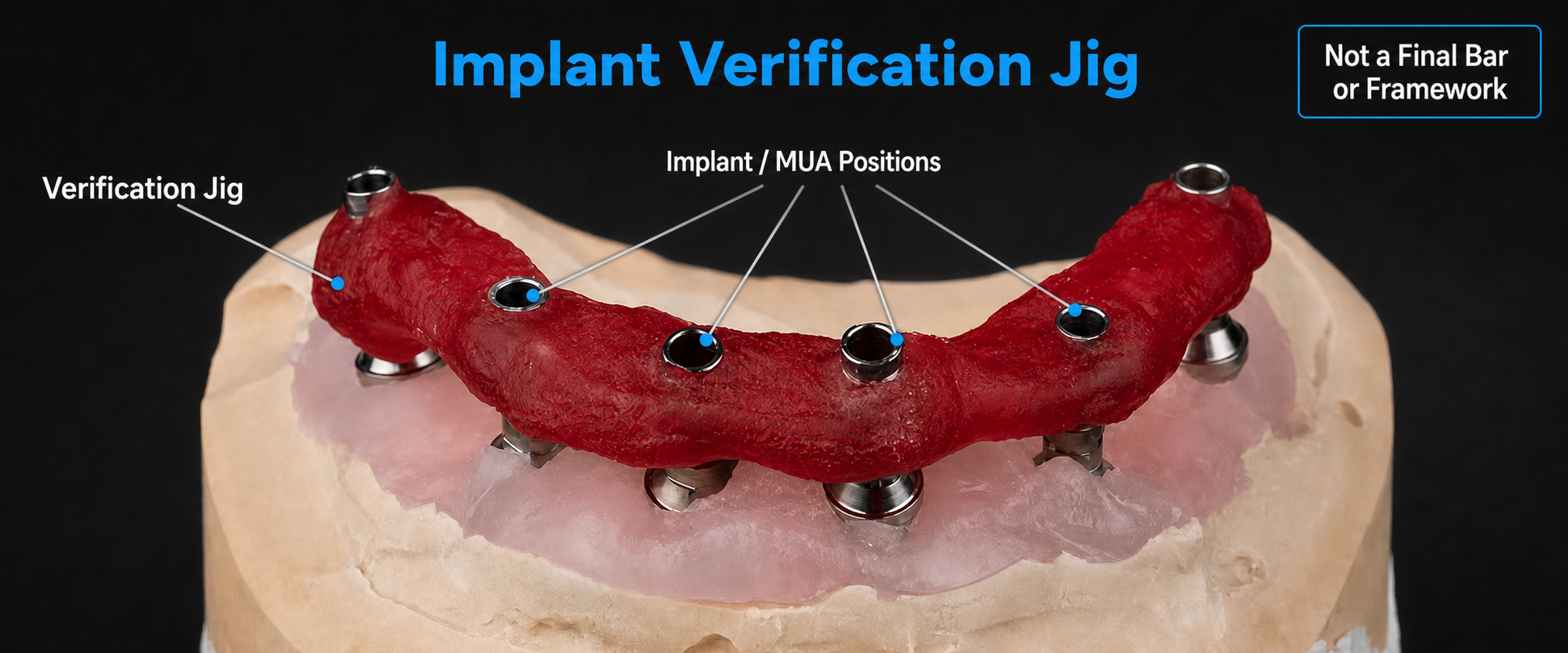 full-arch implants
