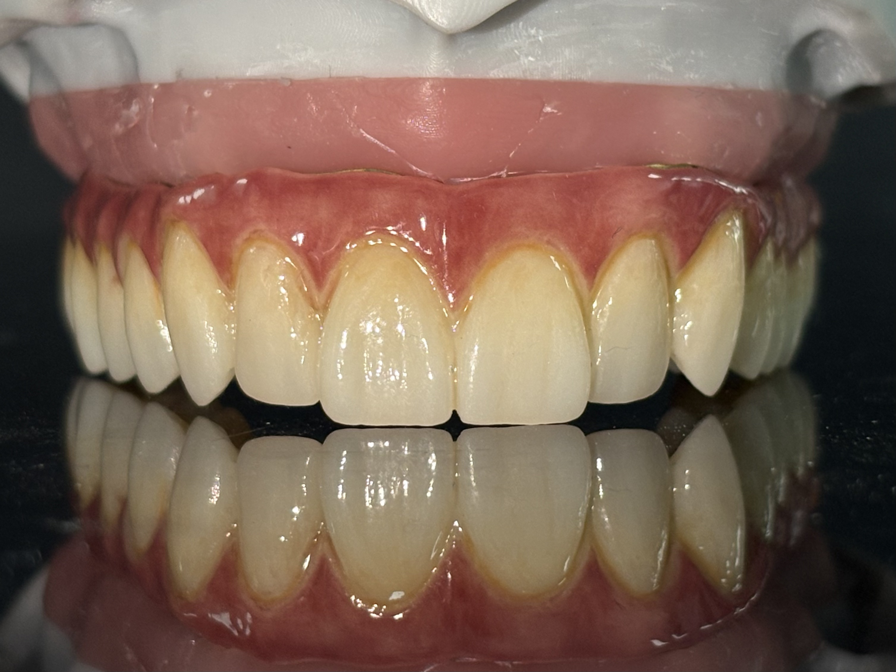 All-on-X Dental Restorations: Prosthesis Options, Materials and Lab Workflow