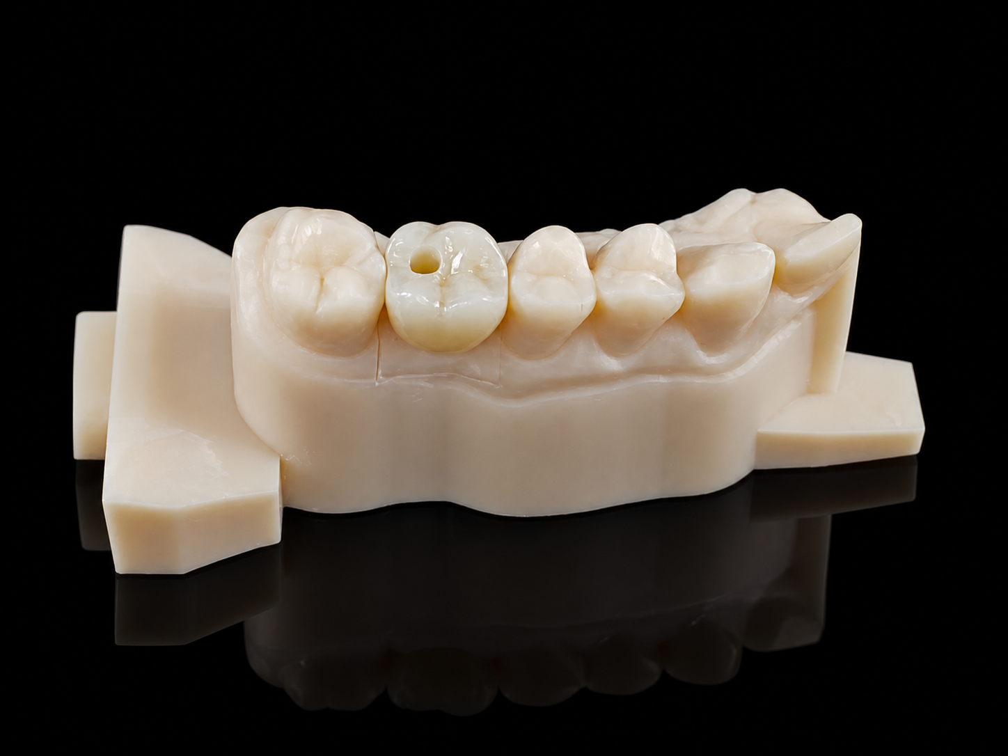 Screw-Retained Implant Crown & Bridge