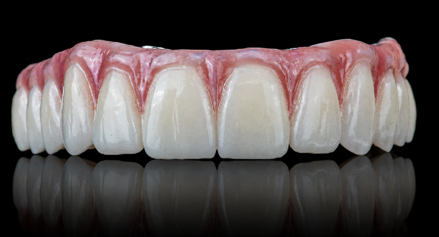 Full-Arch Implant Restoration