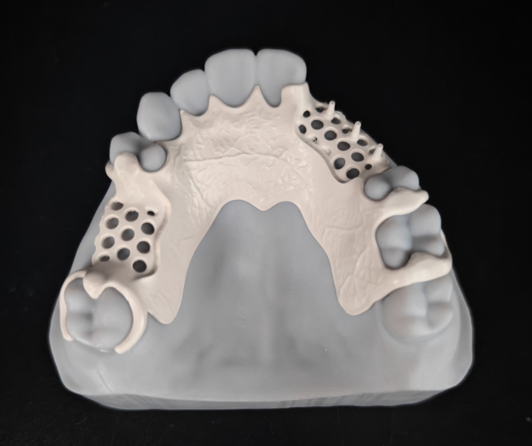 PEEK Partial Denture